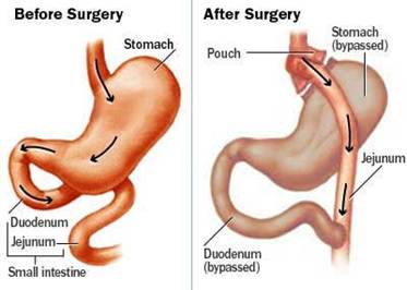 Description: http://www.prlog.org/10091718-gastric-bypass-surgery-prefered-procedure-for-weight-loss.jpg